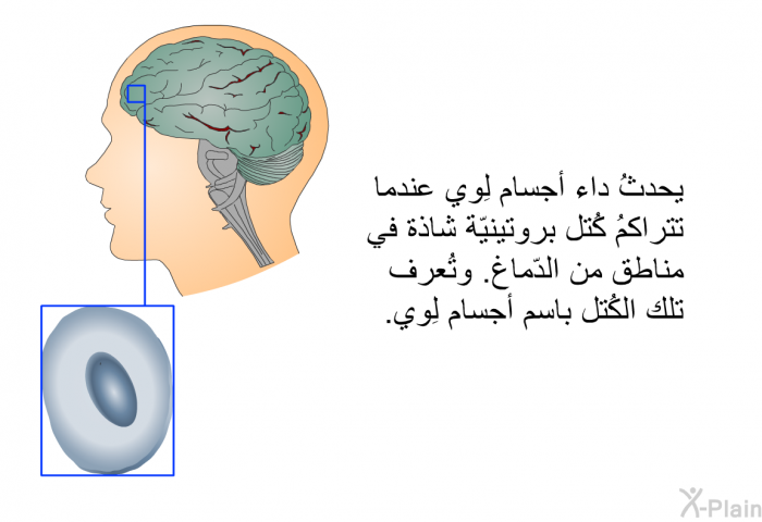 يحدثُ داء أجسام لِوي عندما تتراكمُ كُتل بروتينيّة شاذة في مناطق من الدّماغ. وتُعرف تلك الكُتل باسم أجسام لِوي.