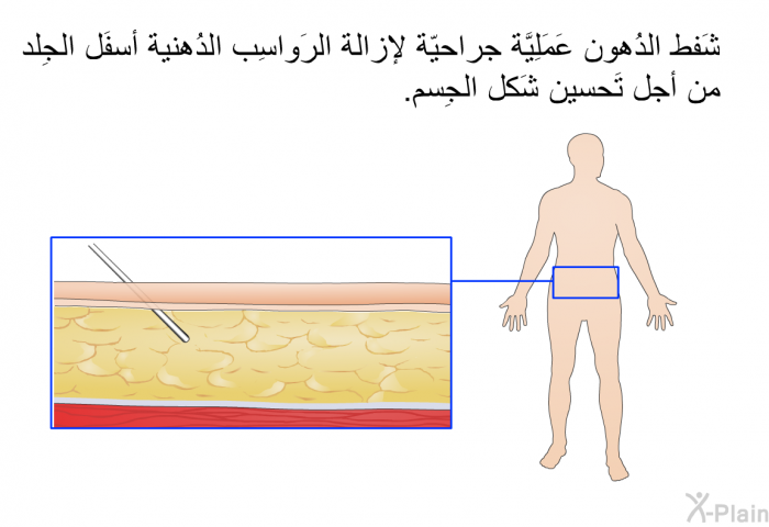 شَفط الدُهون عَمَلِيَّة جِراحيّة لإزالة الرَواسِب الدُهنية أسفَل الجِلد من أجل تَحسين شَكل الجِسم.