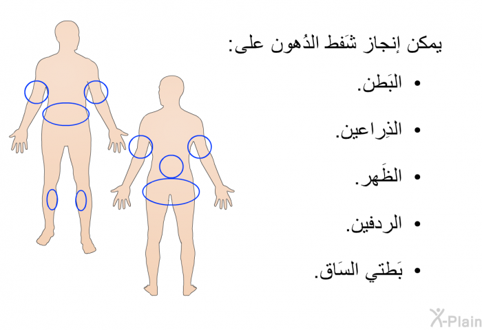 يمكن إنجاز شَفط الدُهون على:   البَطن.  الذِراعين.  الظَهر.  الردفين. بَطتي السَاق.