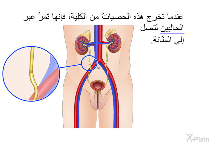 عندما تخرج هذه الحصياتُ من الكلية، فإنها تمرُّ عبر الحالبين لتصل إلى المثانة.