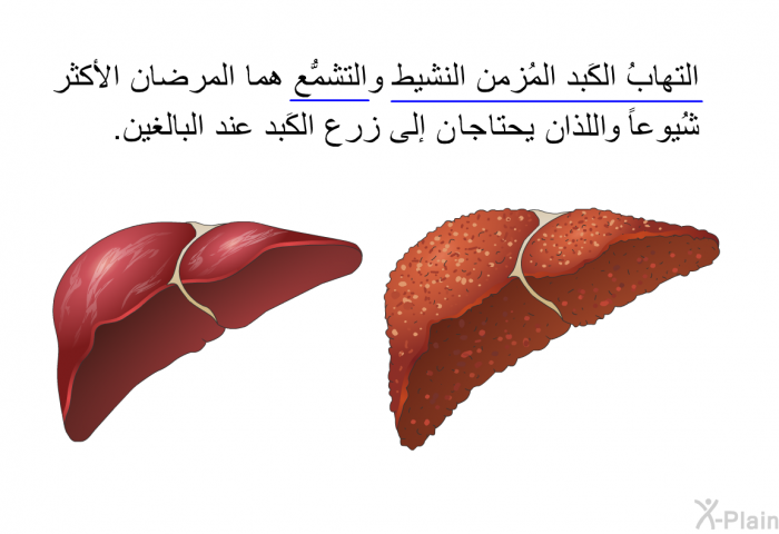 التهابُ الكَبد المُزمن النشيط والتشمُّع هما المرضان الأكثر شُيوعاً واللذان يحتاجُان إلى زرع الكَبد عند البالغين.