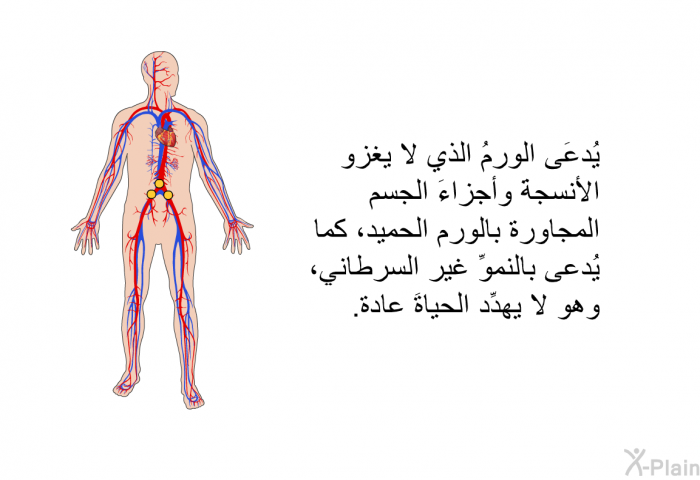 يُدعَى الورمُ الذي لا يغزو الأنسجةَ وأجزاءَ الجسم المجاورة بالورم الحميد، كما يُدعى بالنموِّ غير السرطاني، وهو لا يهدِّد الحياةَ عادة.