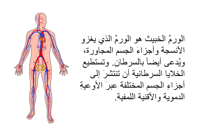 الورمُ الخبيث هو الورمُ الذي يغزو الأنسجةَ وأجزاءَ الجسم المجاورة، ويُدعى أيضاً بالسرطان. وتستطيع الخلايا السرطانيةُ أن تنتشرَ إلى أجزاءِ الجسم المختلفة عبرَ الأوعيةِ الدموية والأقنية اللمفية.
