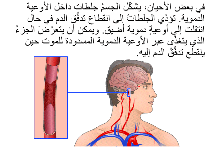 في بعض الأحيان، يشكِّل الجسمُ جلطات داخل الأوعية الدموية. تؤدِّي الجلطاتُ إلى انقطاع تدفُّق الدم في حال انتقلت إلى أوعيةٍ دموية أضيق. ويمكن أن يتعرَّضَ الجزءُ الذي يتغذَّى عبر الأوعية الدموية المسدودة للموت حين ينقطع تدفُّقُ الدم إليه.