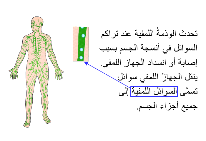 تحدث الوذمةُ اللمفية عند تراكم السوائل في أنسجة الجسم بسبب إصابة أو انسداد الجهاز اللمفي. ينقل الجهازُ اللمفي سوائل تسمَّى السوائل اللمفية إلى جميع أجزاء الجسم.