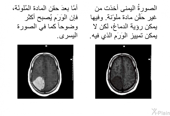 الصورةُ اليمنى أخذت من غير حَقْن مادة ملوّنة. وفيها يمكن رؤية الدماغ، لكن لا يمكن تمييز الوَرَم الذي فيه. أمَّا بعدَ حقن المادة المُلونّة، فإن الوَرَم يُصبح أكثر وضوحاً كما في الصورة اليسرى.