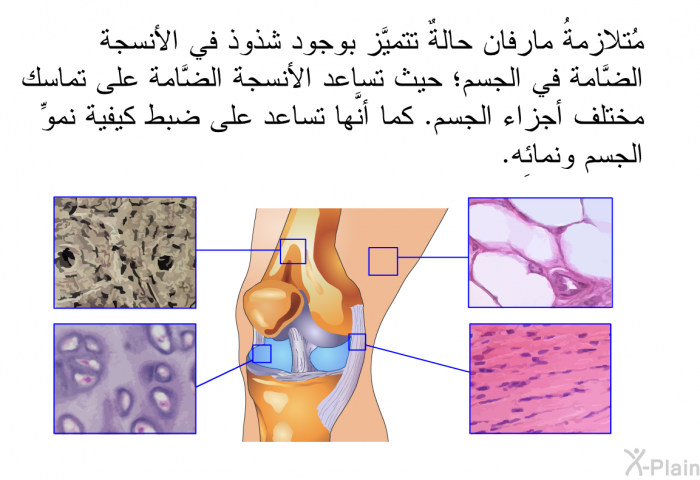 مُتلازمةُ مارفان حالةٌ تتميَّز بوجود شذوذ في الأنسجة الضَّامة في الجسم؛ حيث تساعد الأنسجة الضَّامة على تماسك مختلف أجزاء الجسم. كما أنَّها تساعد على ضبط كيفية نموِّ الجسم ونمائِه.