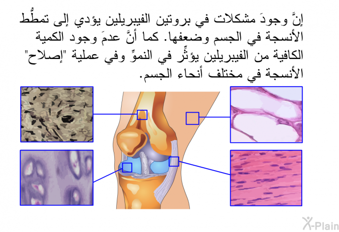 إنَّ وجودَ مشكلات في بروتين الفيبريلين يؤدي إلى تمطُّط الأنسجة في الجسم وضعفها. كما أنَّ عدمَ وجود الكمية الكافية من الفيبريلين يؤثِّر في النموِّ وفي عملية "إصلاح" الأنسجة في مختلف أنحاء الجسم.