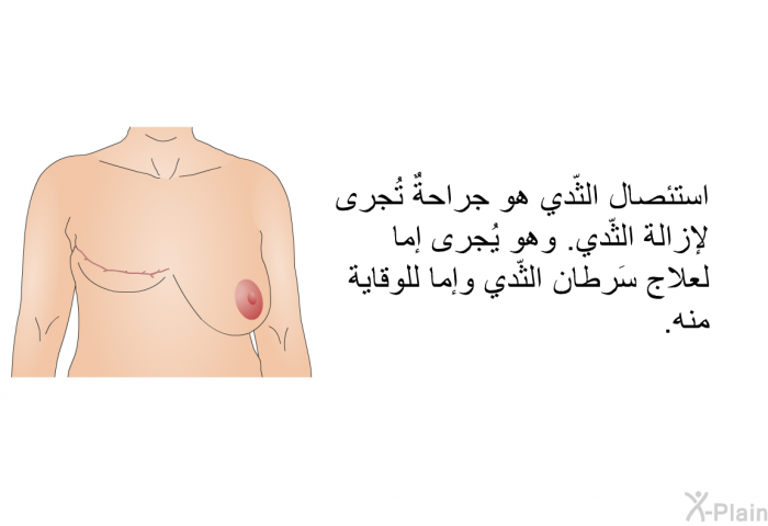 استئصال الثّدي هو جراحةٌ تُجرى لإزالة الثّدي. وهو يُجرى إما لعلاج سَرطان الثّدي وإما للوقاية منه.