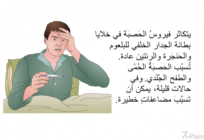 يتكاثر فيروسُ الحَصبَة في خلايا بطانة الجدار الخلفي للبلعوم والحَنجَرة والرئتين عادة. تُسبِّب الحَصبَةُ الحُمَّى والطفح الجِّلدي. وفي حالات قليلة، يمكن أن تسبِّبَ مضاعفاتٍ خطيرة.