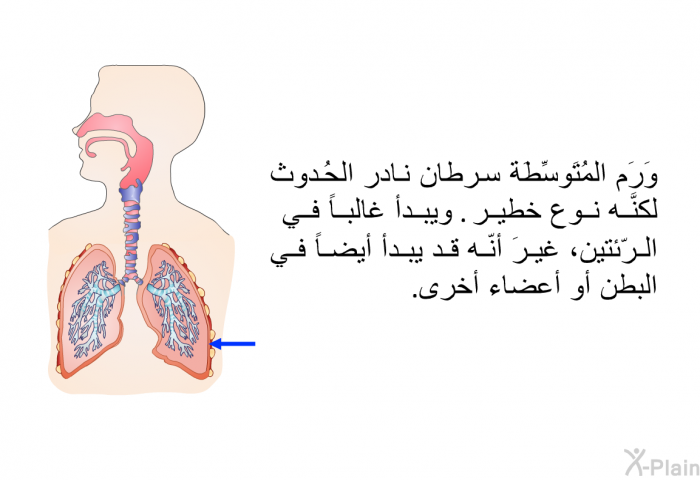 وَرَم المُتَوسِّطَة سرطانٌ نادر الحُدوث لكنَّه نوعٌ خطير. ويبدأ غالباً في الرّئتين، غيرَ أنّه قد يبدأ أيضاً في البطن أو أعضاء أخرى.