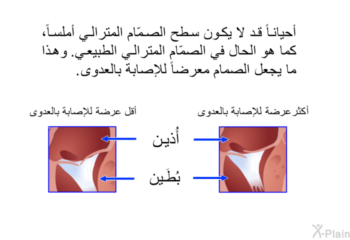 أحياناً قد لا يكون سطح الصمّام المترالي أملساً، كما هو الحال في الصمّام المترالي الطبيعي. وهذا ما يجعل الصمام معرضاً للإصابة بالعدوى.
