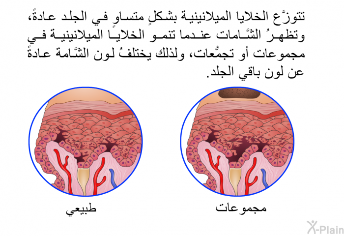 تتوزَّع الخلايا الميلانينية بشكلٍ متساوٍ في الجلد عادةً، وتظهرُ الشَّامات عندما تنمو الخلايا الميلانينية في مجموعات أو تجمُّعات، ولذلك يختلفُ لون الشَّامة عادةً عن لون باقي الجلد.