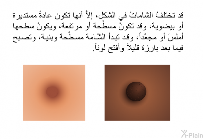 قد تختلفُ الشاماتُ في الشكل، إلاَّ أنها تكون عادةً مستديرة أو بيضوية، وقد تكونُ مسطَّحة أو مرتفعة، ويكونُ سطحها أملسَ أو مجعَّداً، وقد تبدأ الشَّامة مسطَّحة وبنية، وتصبح فيما بعد بارزة قليلاً وأفتح لوناً.