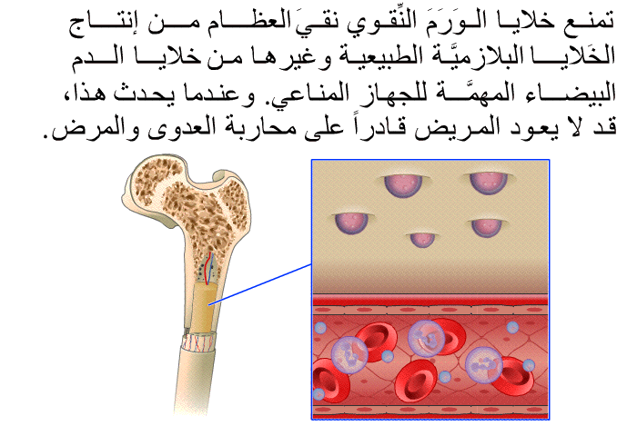 تمنع خلايا الوَرَمَ النِّقوي نقيَ العظام من إنتاج الخَلايا البلازميَّة الطبيعية وغيرها من خلايا الدم البيضاء المهمَّة للجهاز المناعي. وعندما يحدث هذا، قد لا يعود المريض قادراً على محاربة العدوى والمرض.