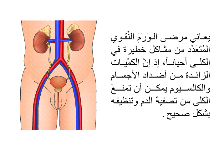 يعاني مرضى الوَرَمَ النِّقويٌّ المُتَعَدِّد من مشاكل خطيرة في الكلى أحياناً، إذ إنَّ الكمِّيات الزائدة من أضداد الأجسام والكالسيوم يمكن أن تمنعَ الكلى من تصفية الدم وتنظيفه بشكل صحيح.