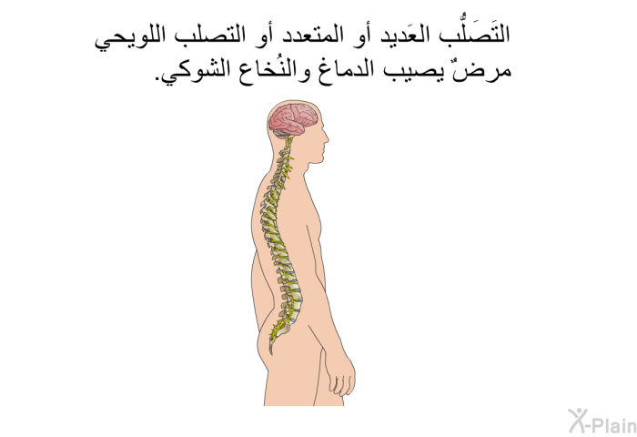 التَصَلُّب العَديد أو المتعدد أو التصلب اللويحي مرضٌ يصيب الدماغ والنُخاع الشوكي.