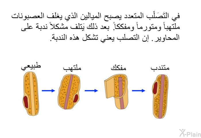 في التَصَلّب المتعدد يصبح الميالين الذي يغلف العصبونات ملتهباً ومتورماً ومفككاً. بعد ذلك يَتلف مشكلاً ندبة على المحاوير. إن التصلب يعني تشكل هذه الندبة.