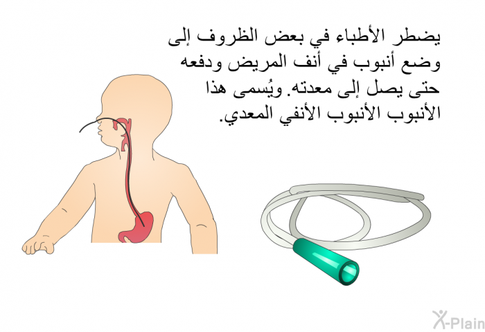 يضطرُّ الأطبَّاءُ في بعض الظروف إلى وضع أنبوب في أنف المريض، ودفعه حتَّى يصل إلى معدته. ويُسمَّى هذا الأنبوبُ الأنبوبَ الأنفي المعدي.