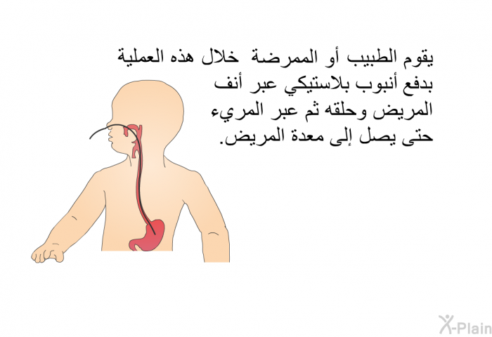 يقوم الطبيبُ أو الممرضة خلال هذه العملية بدفع أنبوب بلاستيكي عبر أنف المريض وحلقه، ثمَّ عبر المريء حتَّى يصل إلى معدة المريض.