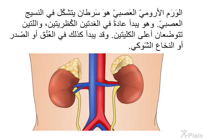 الوَرَم الأروميّ العَصبيّ هوَ سَرطان يتشكّل في النسيج العصبيّ. وهو يبدأُ عادةً في الغدتين الكُظريتين، واللتين تتوضّعان أعلى الكليتين. وقد يبدأ كذلك في العُنُق أو الصّدر أو النخاع الشّوكي.