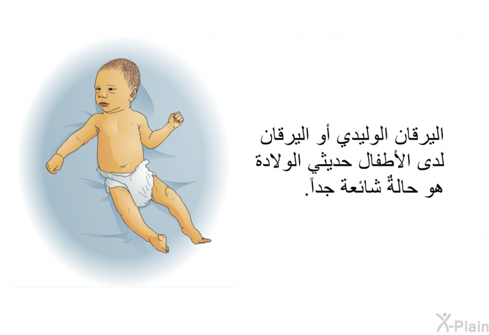اليرقان الوليدي أو اليرقان لدى الأطفال حديثي الولادة هو حالةٌ شائعة جداً.