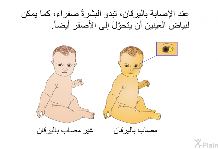عند الإصابة باليرقان، تبدو البشرةُ صفراء، كما يمكن لبياض العينين أن يتحوَّلَ إلى الأصفر أيضاً.