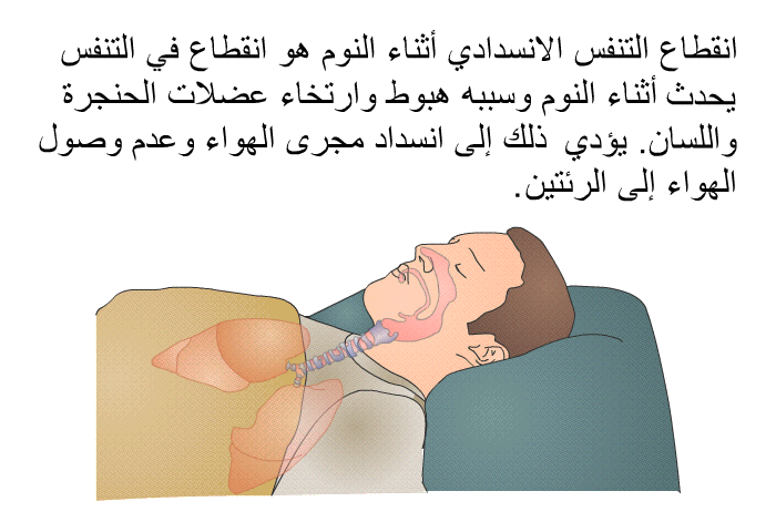 انقطاع التنفس الانسدادي أثناء النوم هو انقطاع في التنفس يحدث أثناء النوم وسببه هبوط وارتخاء عضلات الحنجرة واللسان<B>.</B><B> </B>يؤدي ذلك إلى انسداد مجرى الهواء وعدم وصول الهواء إلى الرئتين<B>. </B>