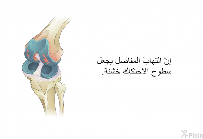 إنَّ التهابَ المفاصل يجعل سطوحَ الاحتكاك خشنةً.