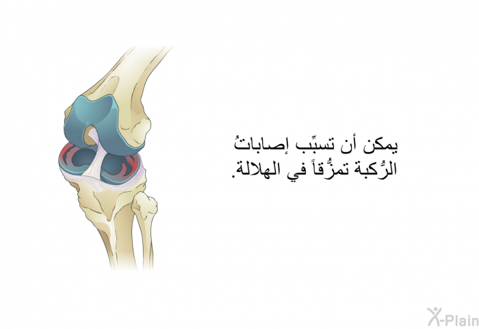 يمكن أن تسبِّب إصاباتُ الرُّكبة تمزُّقاً في الهلالة.