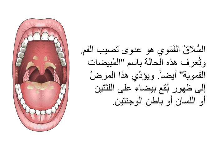 السُّلاقُ الفَمَوي هو عدوى تصيب الفم. وتُعرف هذه الحالة باسم "المُبيضات الفموية" أيضاً. ويؤدِّي هذا المرضُ إلى ظهور بُقع بيضاء على اللثتين أو اللسان أو باطن الوجنتين.