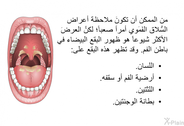 من الممكن أن تكونَ ملاحظة أعراض السُّلاق الفَمَوي أمراً صعباً؛ لكنَّ العرضَ الأكثر شيوعاً هو ظهور البقع البيضاء في باطن الفم. وقد تظهر هذه البقع على:   اللسان.  أرضية الفم أو سقفه.  اللثتين.  بطانة الوجنتين.