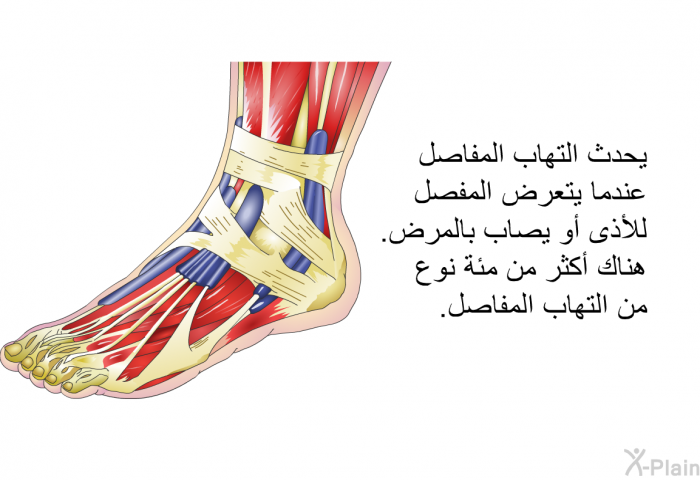 يحدث التهاب المفاصل عندما يتعرض المفصل للأذى أو يصاب بالمرض. هناك أكثر من مئة نوع من التهاب المفاصل.