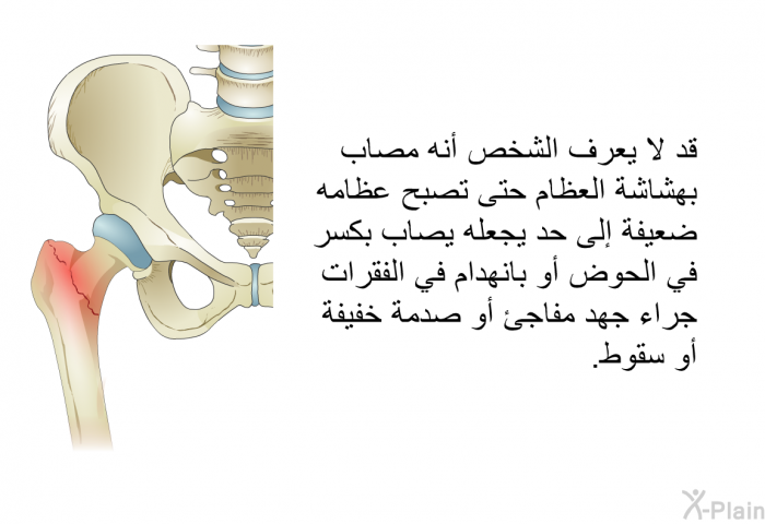 قد لا يعرف الشخص أنه مصاب بهشاشة العظام حتى تصبح عظامه ضعيفة إلى حد يجعله يصاب بكسر في الحوض أو بانهدام في الفقرات جراء جهد مفاجئ أو صدمة خفيفة أو سقوط<B>.</B>