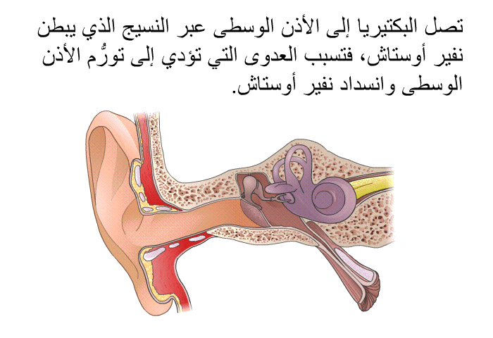 تصل البكتيريا إلى الأذن الوسطى عبر النسيج الذي يبطن نفير أوستاش، فتسبب العدوى التي تؤدي إلى تورُّم الأذن الوسطى وانسداد نفير أوستاش.