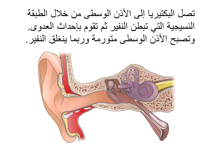 تصل البكتيريا إلى الأذن الوسطى من خلال الطبقة النسيجية التي تبطن النفير ثم تقوم بإحداث العدوى. وتصبح الأذن الوسطى متورمة وربما ينغلق النفير.