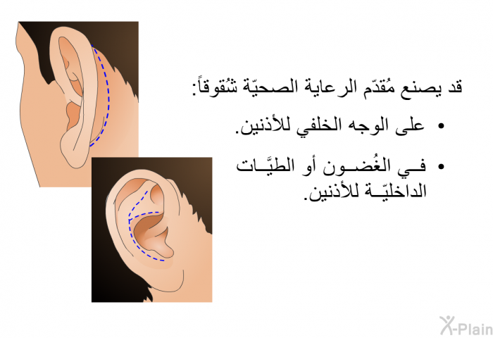 قد يصنع مُقدّم الرعاية الصحيّة شُقوقاً:  على الوجه الخلفي للأذنين. في الغُضون أو الطيَّات الداخليّة للأذنين.