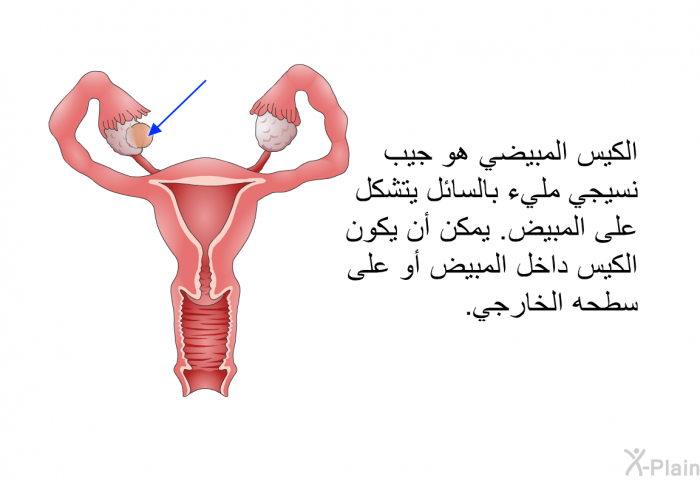 الكيس المبيضي هو جيب نسيجي مليء بالسائل يتشكل على المبيض. يمكن أن يكون الكيس داخل المبيض أو على سطحه الخارجي.