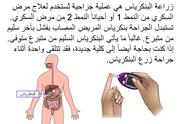 زراعة البنكرياس هي عملية جراحية تُستخدم لعلاج مرض السكري من النمط 1 أو أحياناً النمط 2 من مرض السكري. تستبدل الجراحة بنكرياس المريض المصاب بفشل سليم من متبرع. غالباً ما يأتي البنكرياس السليم من متبرع متوفى. إذا كنت بحاجة أيضاً إلى كلية جديدة، فقد تتلقى واحدة أثناء جراحة زرع البنكرياس.