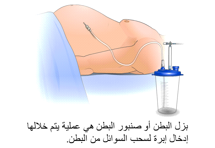 بزل البطن أو صنبور البطن هي عملية يتم خلالها إدخال إبرة لسحب السوائل من البطن.