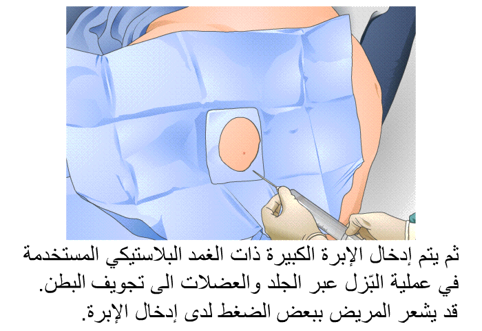 ثم يتم إدخال الإبرة الكبيرة ذات الغمد البلاستيكي المستخدمة في عملية البّزل عبر الجلد والعضلات الى تجويف البطن. قد يشعر المريض ببعض الضغط لدى إدخال الإبرة.
