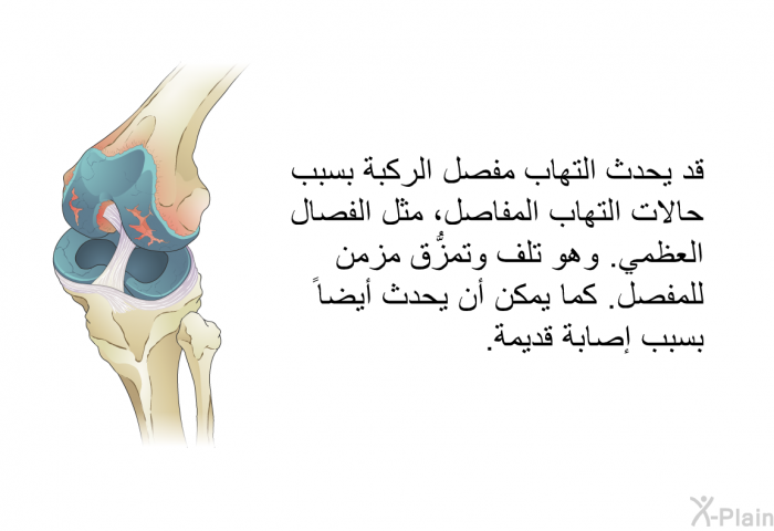 قد يحدث التهاب مفصل الركبة بسبب حالات التهاب المفاصل، مثل الفصال العظمي. وهو تلف وتمزُّق مزمن للمفصل. كما يمكن أن يحدث أيضاً بسبب إصابة قديمة.