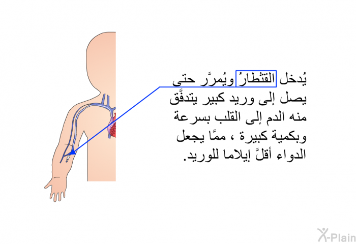 يُدخل القثطارُ ويُمرَّر حتى يصل إلى وريد كبير يتدفَّق منه الدم إلى القلب بسرعة وبكمية كبيرة ، ممَّا يجعل الدواء أقلَّ إيلاما للوريد.