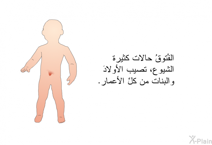 الفُتوقُ حالات كثيرة الشيوع، تصيب الأولادَ والبنات من كلِّ الأعمار.