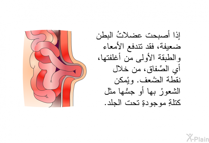 إذا أصبحت عضلاتُ البطن ضعيفةً، فقد تندفع الأمعاء والطبقة الأولى من أغلفتها، أي الصِّفاق، من خلال نقطة الضَّعف. ويُمكن الشعورُ بها أو جسُّها مثل كتلةٍ موجودةٍ تحت الجلد.