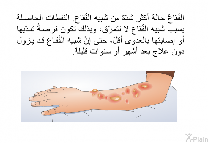 الفُقاعُ حالة أكثر شدّة من شبيه الفُقاع. النفطات الحاصلة بسبب شبيه الفُقاع لا تتمزّق، وبذلك تكون فرصةُ تندّبها أو إصابتها بالعدوى أقلّ، حتى إنَّ شبيه الفُقاع قد يزول دون علاج بعد أشهر أو سنوات قليلة.