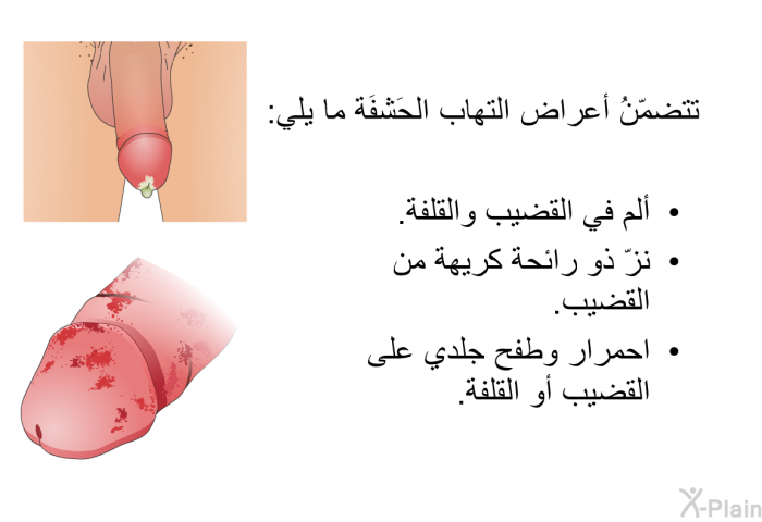 تتضمّنُ أعراض التهاب الحَشفَة ما يلي:  ألم في القضيب والقلفة. نزّ ذو رائحة كريهة من القضيب. احمرار وطفح جلدي على القضيب أو القلفة.