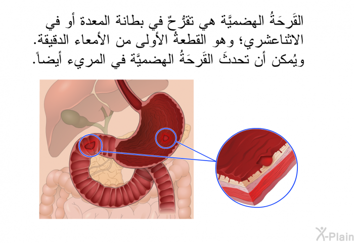 القَرحَةُ الهضميَّة هي تقرُّحٌ في بطانة المعدة أو في الاثناعشري؛ وهو القطعةُ الأُولى من الأمعاء الدقيقة. ويُمكن أن تحدثَ القَرحَةُ الهضميَّة في المريء أيضاً.