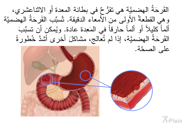 القَرحَةُ الهضميَّة هي تقرُّحٌ في بطانة المعدة أو الاثناعشري، وهي القطعةُ الأُولى من الأمعاء الدقيقة. تُسبِّب القَرحَةُ الهضميَّة ألماً كليلاً أو ألماً حارقاً في المَعِدة عادة. ويُمكن أن تسبِّبَ القَرحَةُ الهضميَّة، إذا لم تُعالج، مشاكلَ أُخرى أشدَّ خُطورةً على الصحَّة.