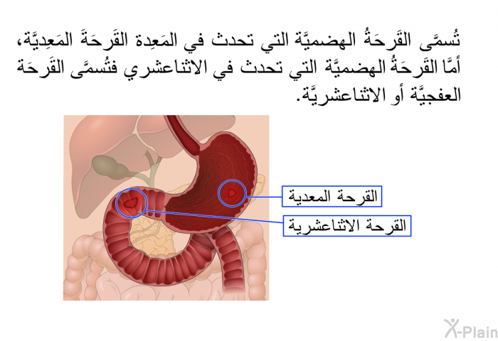 تُسمَّى القَرحَةُ الهضميَّة التي تحدث في المَعِدة القَرحَةَ المَعِديَّة، أمَّا القَرحَةُ الهضميَّة التي تحدث في الاثناعشري فتُسمَّى القَرحَةَ العفجيَّة أو الاثناعشريَّة.